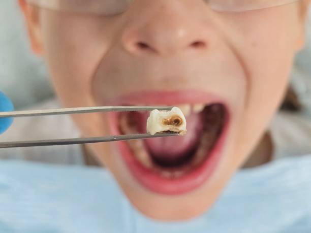 Best Emergency Wisdom Teeth Removal in Humboldt, IA